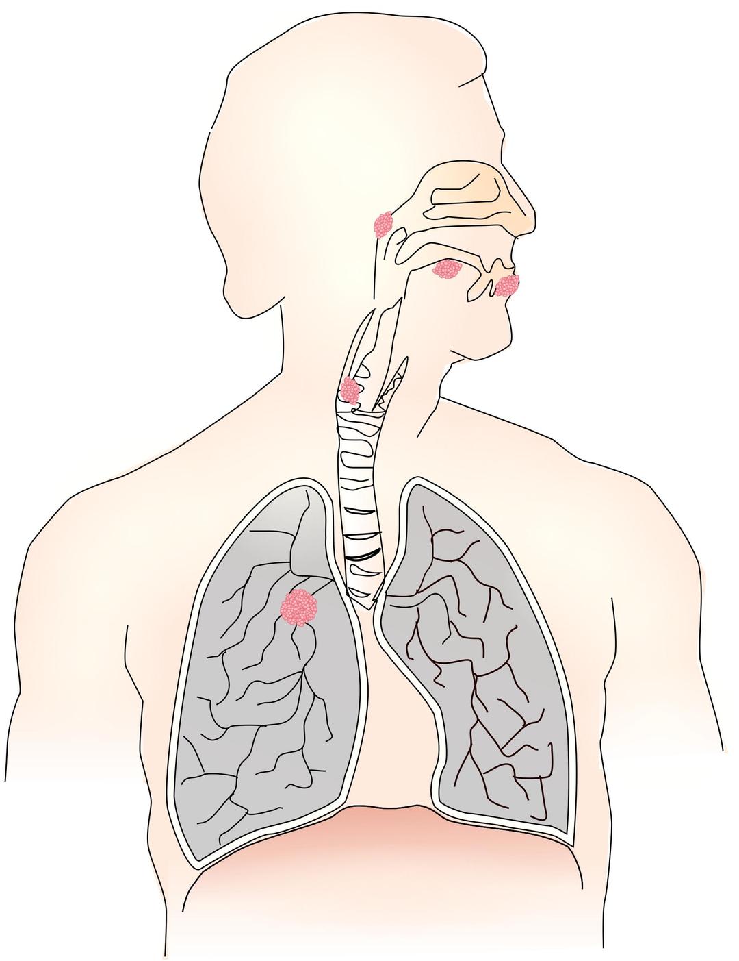 Cancer caused by smoking I png transparent