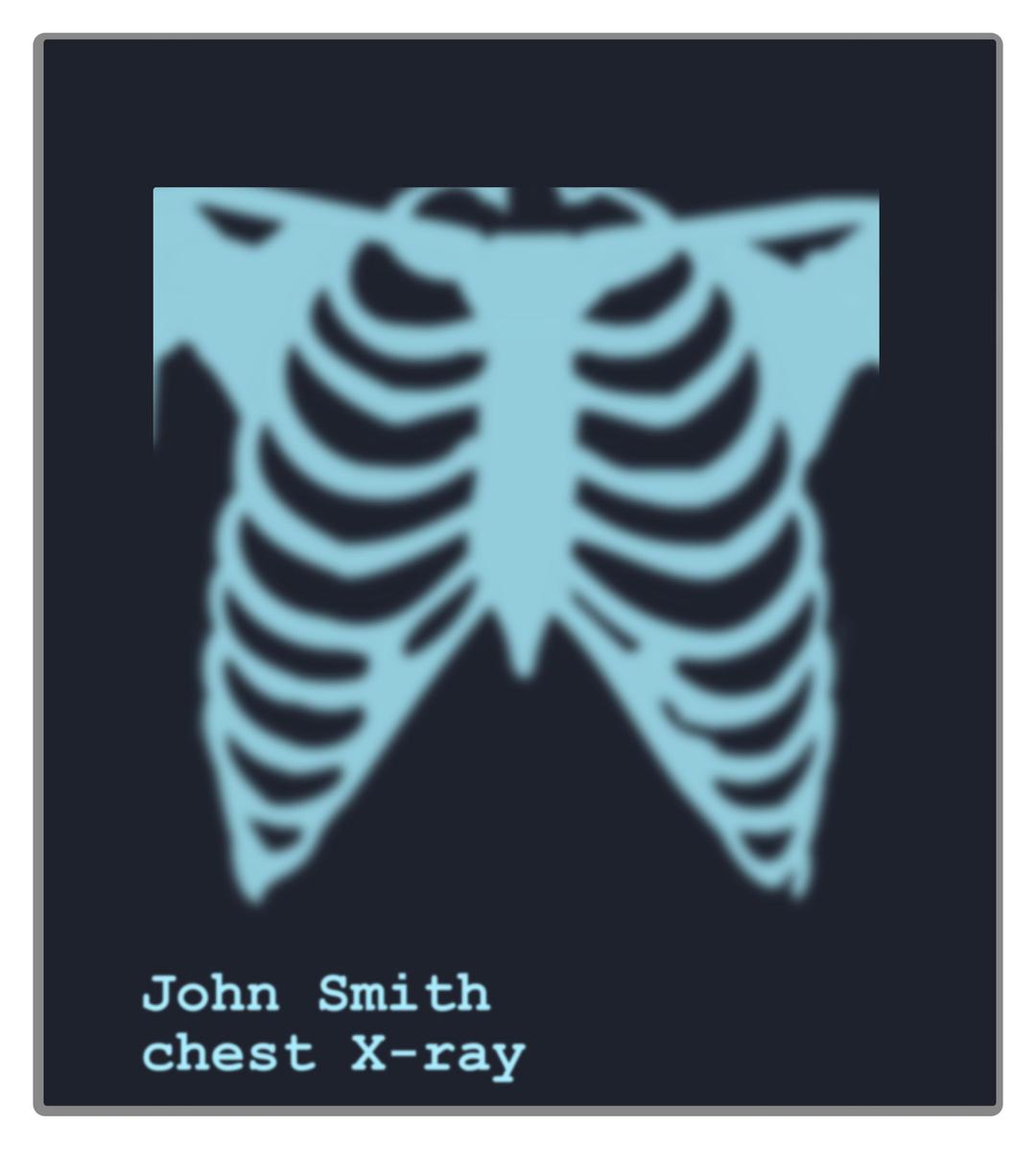 Chest X-ray image png transparent