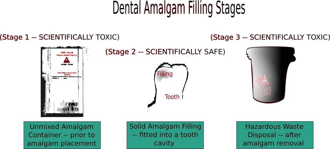 Dental Amalgam Filling Stages png transparent