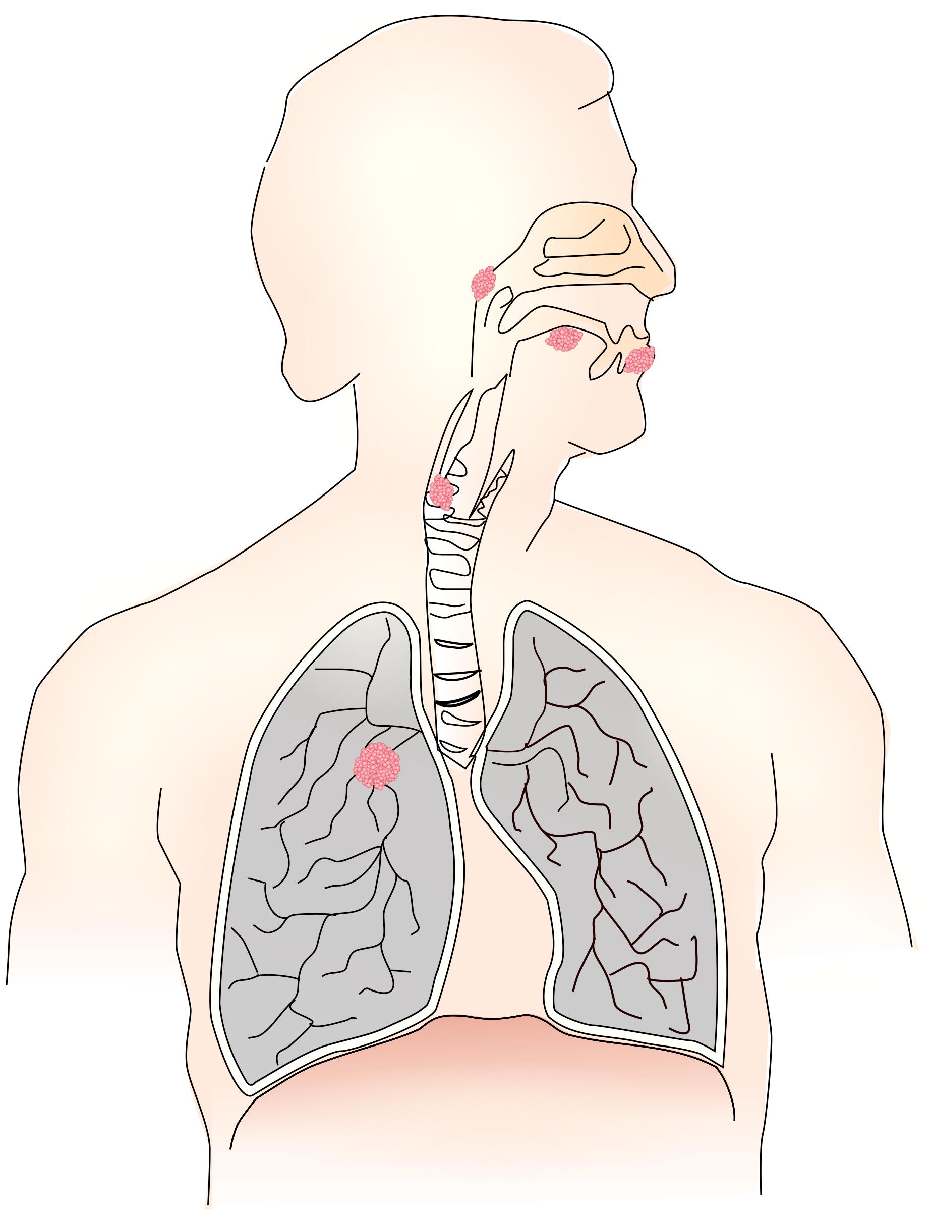 Cancer caused by smoking I png